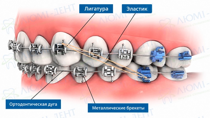 Элементы брекет системы Что такое брекеты фото Люми-Дент