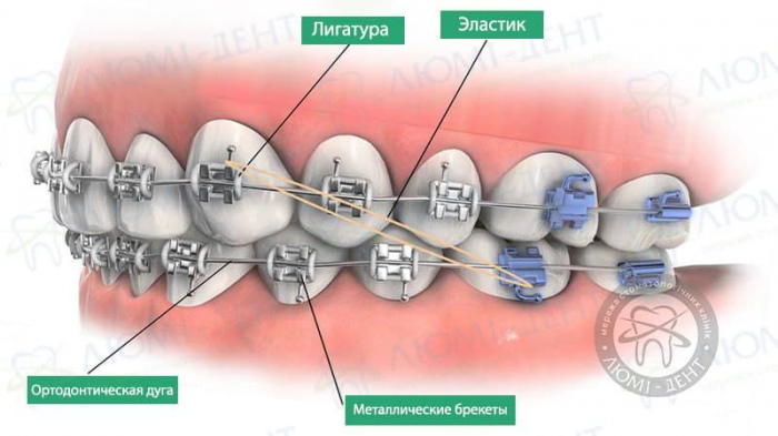 Что такое брекеты фото Люми-Дент