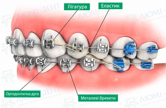 Елементи брекет системи Що таке брекети фото Люмі-Дент