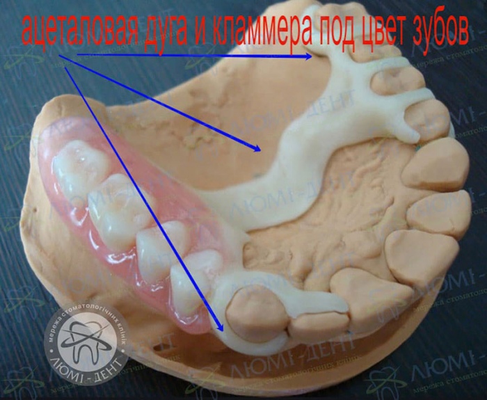 Ацеталовый бюгельный протез фото Люми-Дент