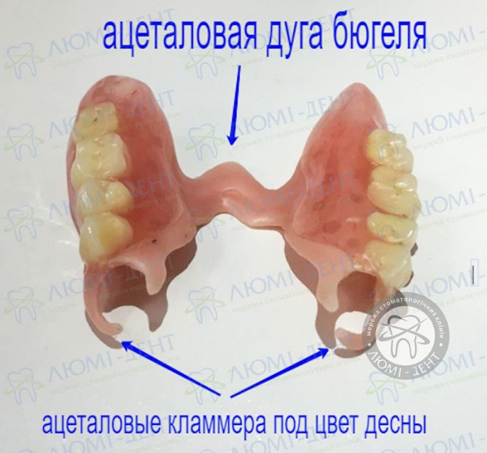 Ацеталовый бюгельный протез фото Люми-Дент