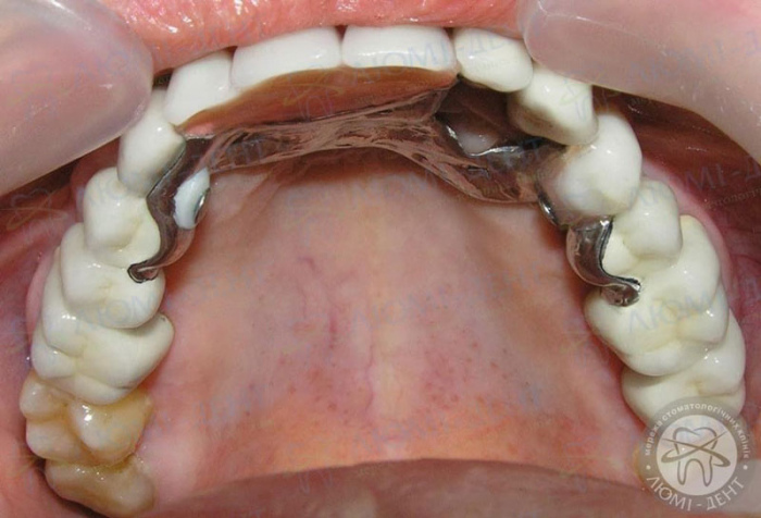 бюгельний протез в роті фото ЛюміДент