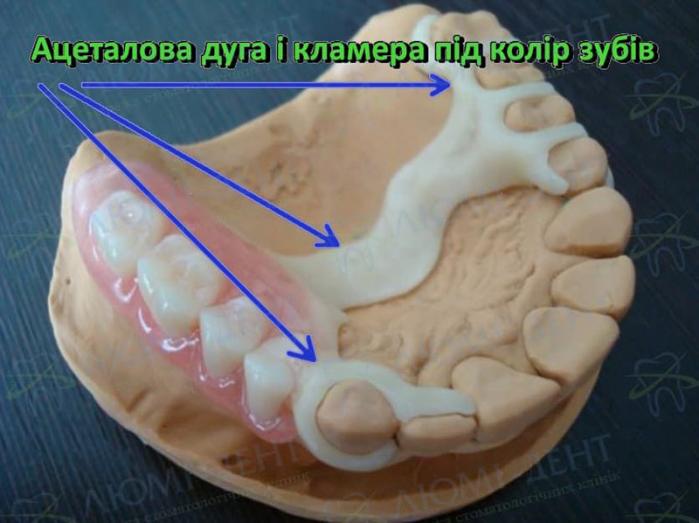 Ацеталовий бюгельний протез з білими кламерами Що таке бюгельний протез фото Люмі-Дент