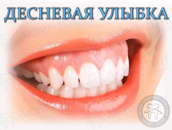 гингивальная улыбка фото Люми-Дент