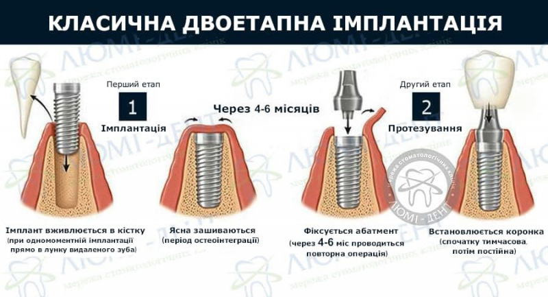 Двоетапна імплантація фото ЛюміДент