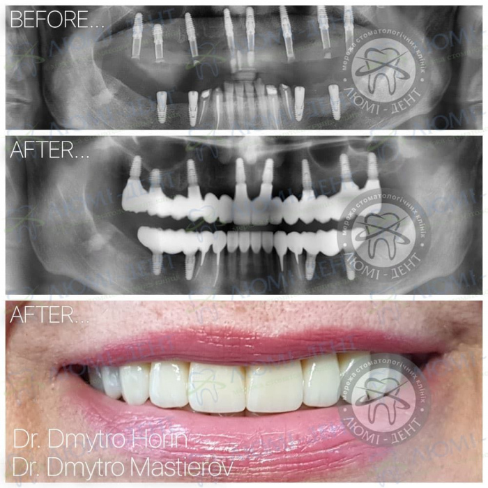 Двоетапна імплантація зубів фото ЛюміДент