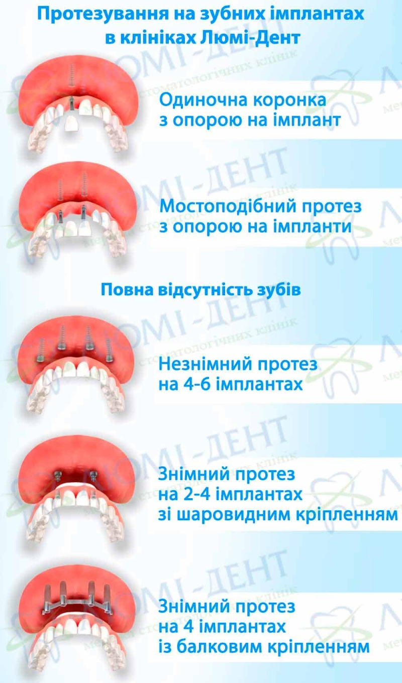 Експрес імплантація зубів що це фото Люмі-Дент