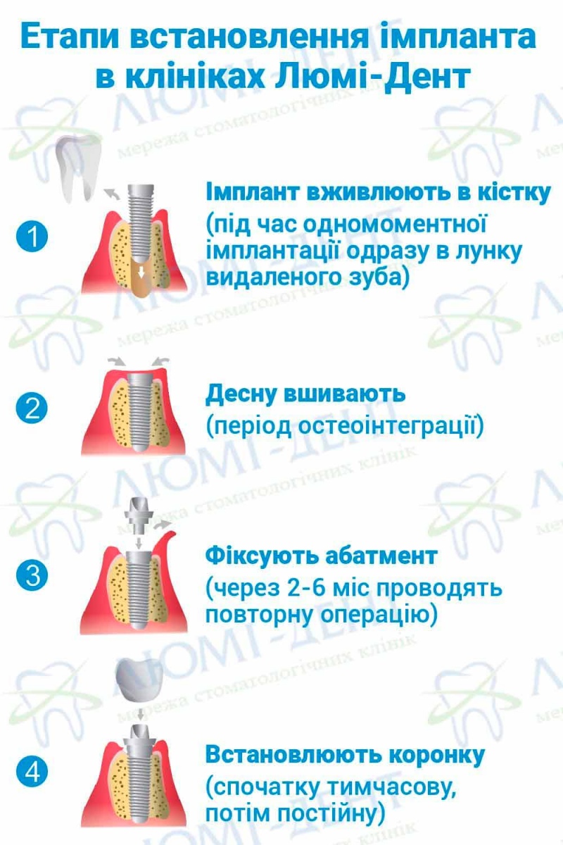 Експрес імплантація зубів відгуки фото Люмі-Дент