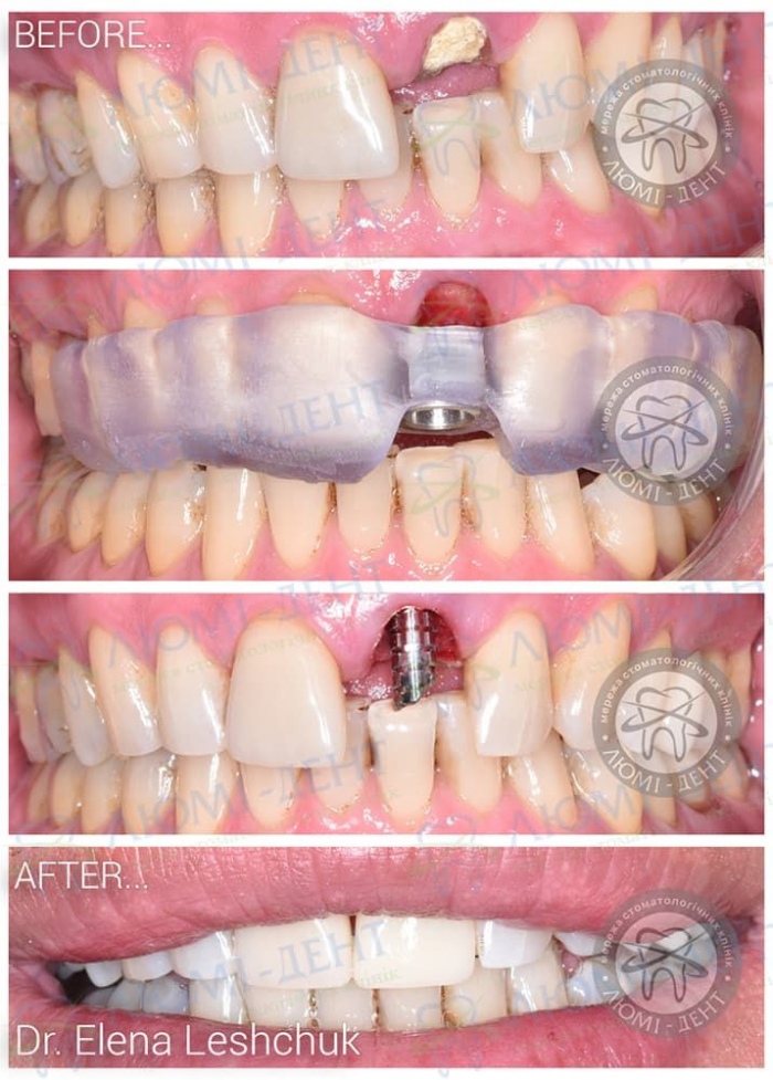 Недоліки експрес імплантації зубів фото Люмі-Дент