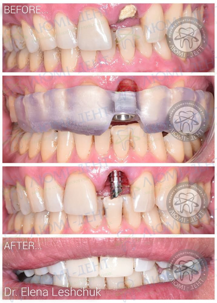 Недоліки експрес імплантації зубів фото ЛюміДент
