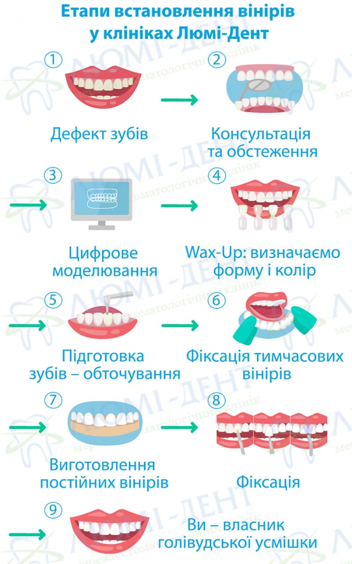 Етапи встановлення вінірів Як зробити голлівудську усмішку фото Люмі-Дент