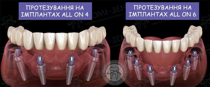 Імплантація all on 4 фото Люмі-Дент