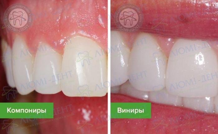Компониры что это такое фото Люми-Дент