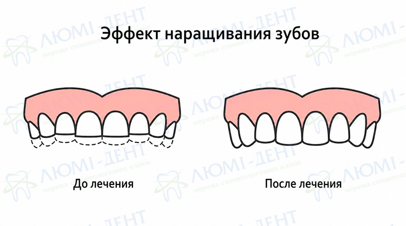 Эффект наращивания зубов Наращивание передних зубов фото ЛюмиДент