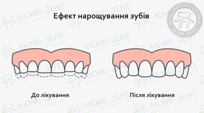 Нарощування передніх зубів фото ЛюміДент