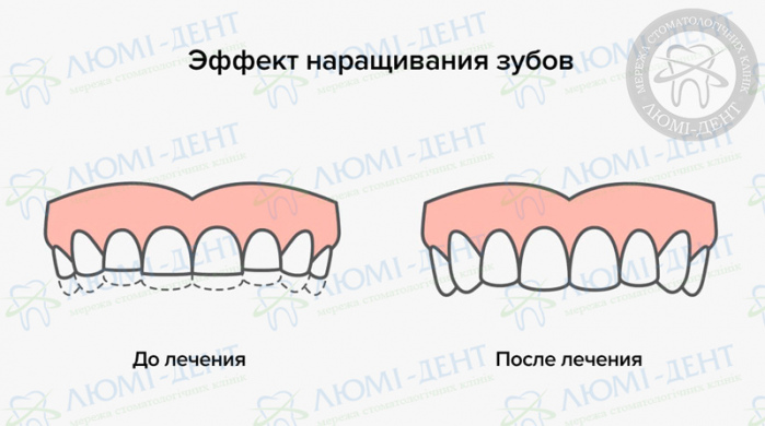 Наращивание передних зубов фото ЛюмиДент