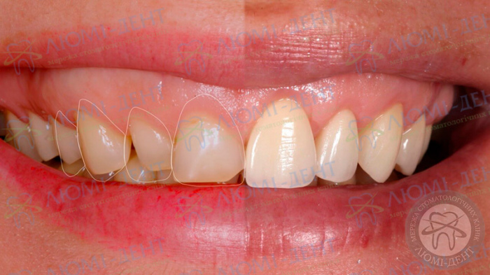 Нарощування жувальних зубів фото ЛюміДент