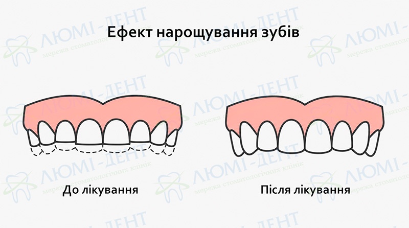 Ефект нарощування зубів Нарощування передніх зубів фото ЛюміДент