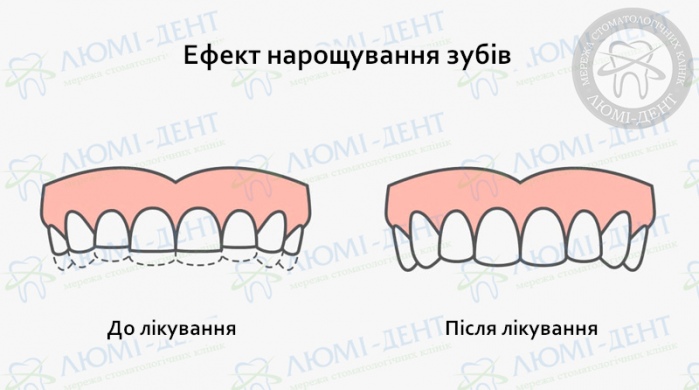 нарощування зубів фото Люмі-Дент