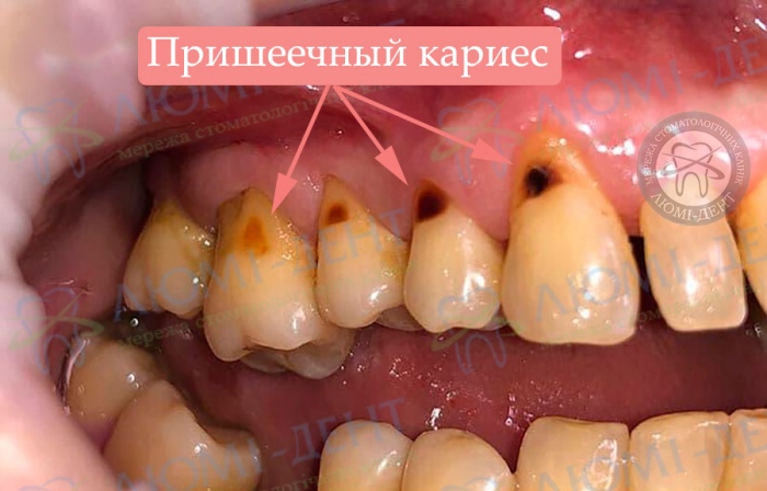 Пришеечный кариес фото Люми-Дент