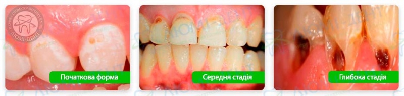 Карієс пришийковий фото Люмі-Дент