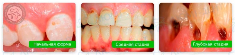 Пришейковый кариес фото Люми-Дент
