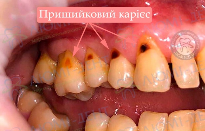 Пришийковий карієс фото Люмі-Дент