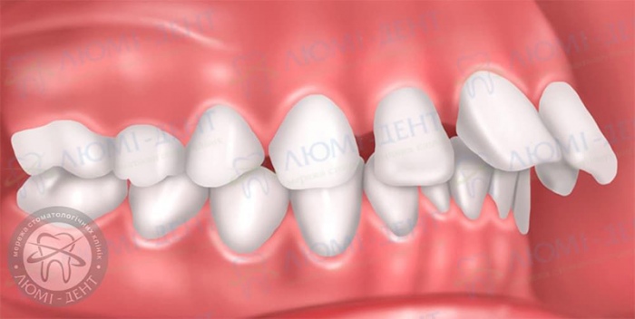 Протрузія зубів фото Люмі-Дент