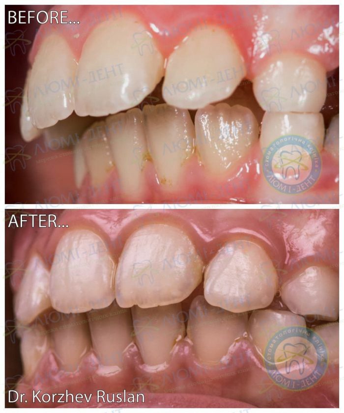Протрузия зубов после брекетов фото ЛюмиДент