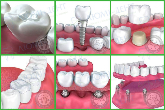 Як роблять реставрацію зубів фото ЛюміДент