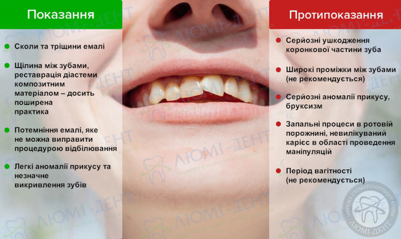 Методи реставрації зубів фото ЛюміДент