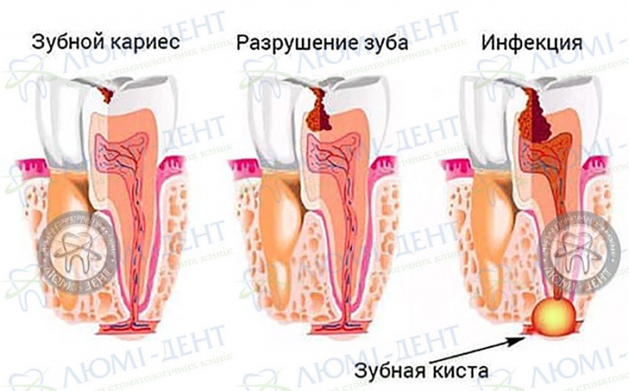 Резекция зуба фото Люми-Дент