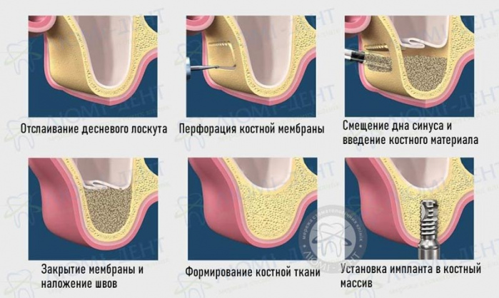 как делают синус лифтинг фото Люми-Дент