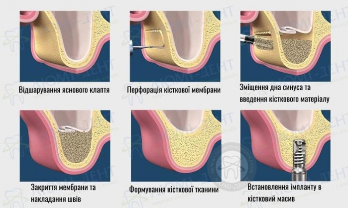 як роблять синус ліфтинг фото Люмі-Дент