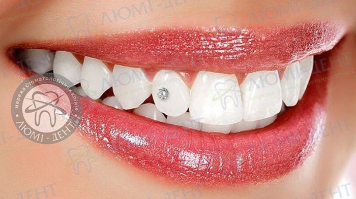 Стрази на зуби фото Люмі-Дент