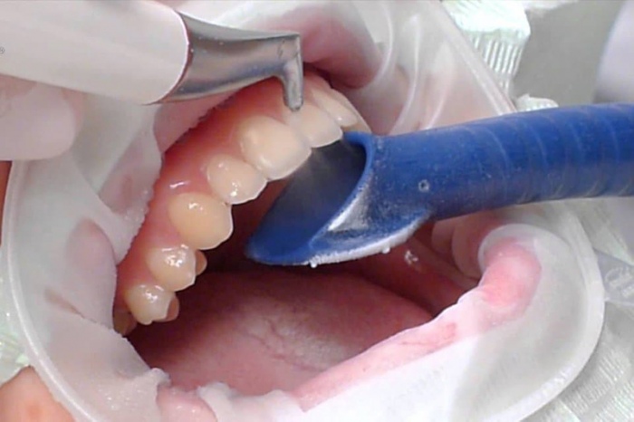 Чистка ультразвуком зубов фото Люми-Дент