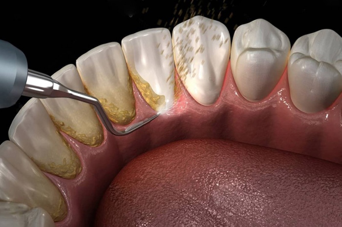 Чистка зубов ультразвуком фото Люми-Дент