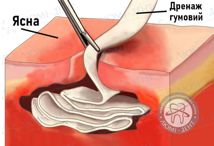 дренаж ясен фото ЛюміДент
