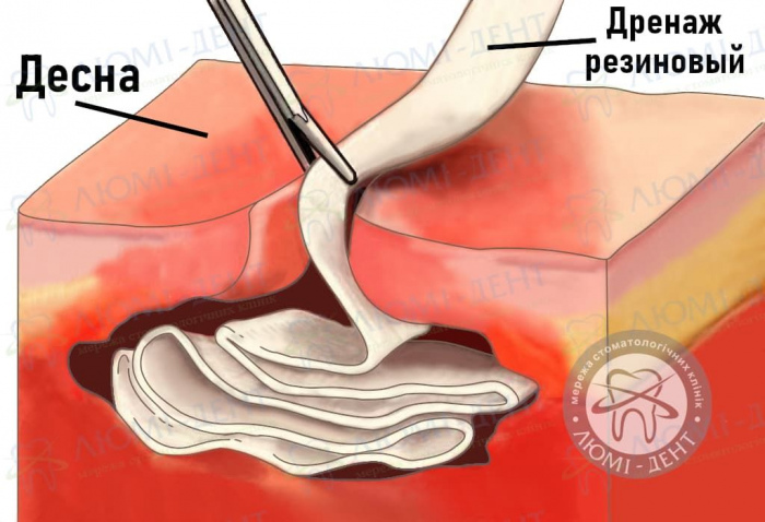 дренаж десны фото ЛюмиДент