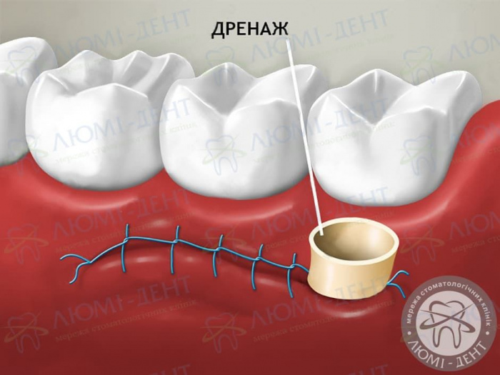 дренаж в стоматологии фото ЛюмиДент