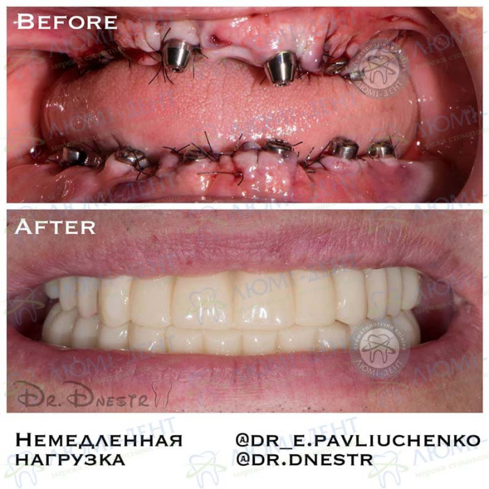 Приживаемость имплантов зубов фото Люми-Дент