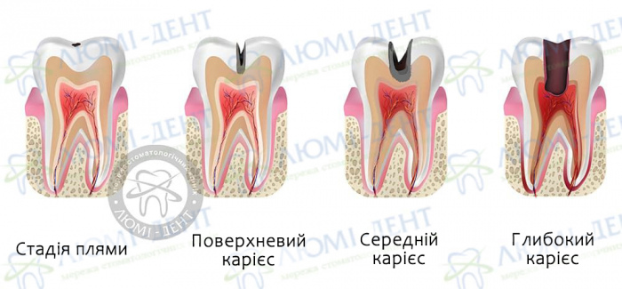 Як лікувати карієс фото ЛюміДент