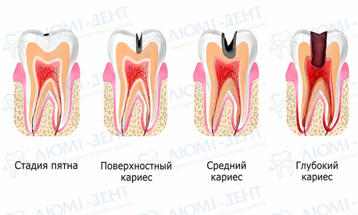 Как лечить кариес фото Люми-Дент