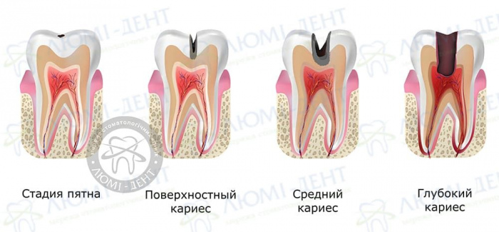 Как лечить кариес фото Люми-Дент