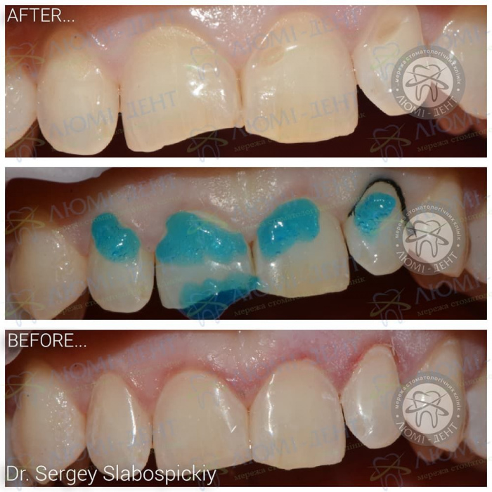 Как выглядит кариес фото Люми-Дент