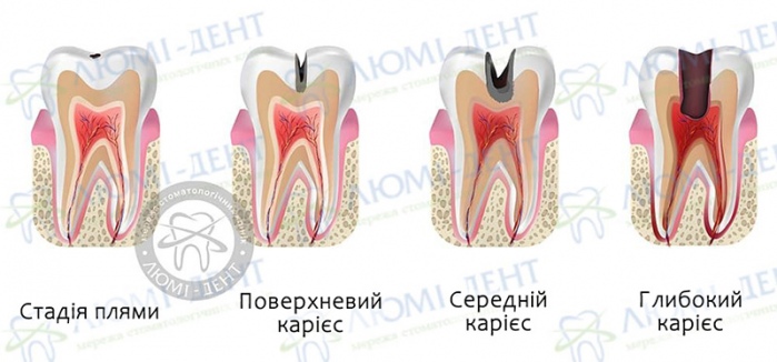 Як лікується карієс фото Люмі-Дент