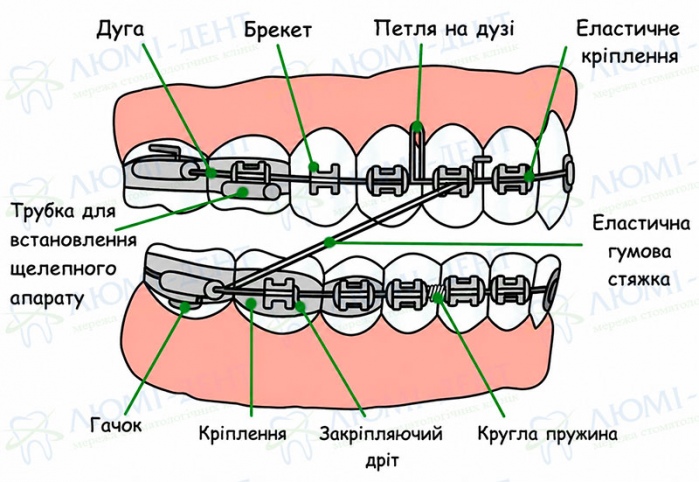 Складові частини брекетів Брекети на зубах фото Люмі-Дент