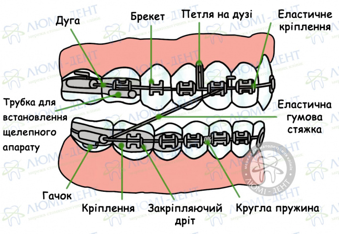 як ставлять брекети фото ЛюміДент