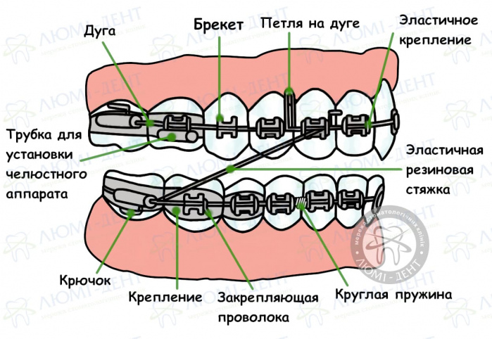 Как ставят брекеты фото Люми-Дент