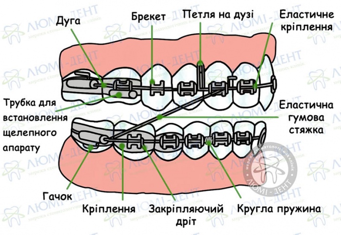 Брекети на зубах фото Люмі-Дент